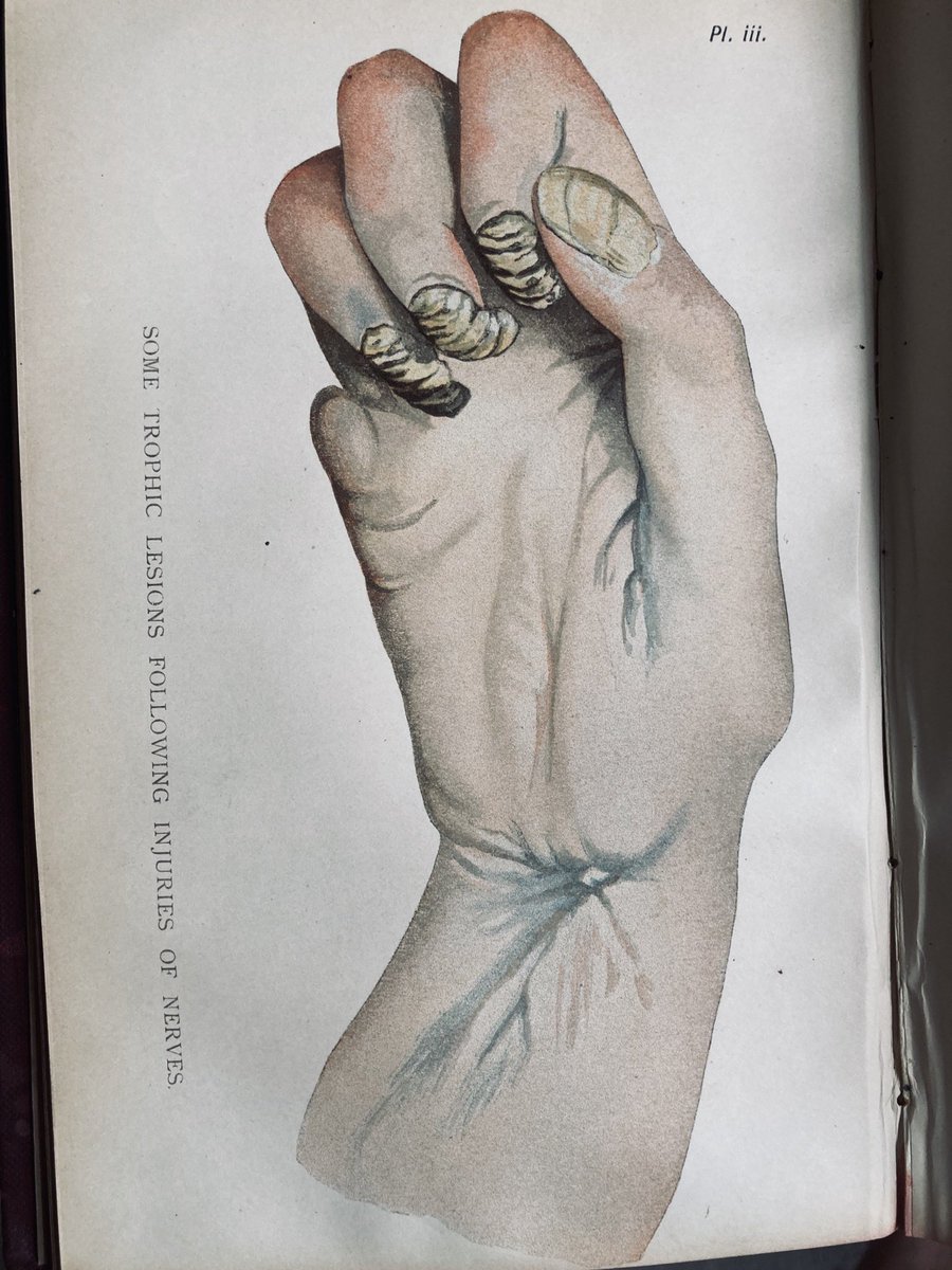 TJQPNI's tweet photo. #median #nerveinjury at the wrist demonstrating tropic changes: From 1889 ‘Injuries and disease of nerves’ by A.A.Bowlby #historyofmedicine #meded #surgicalillustration #trauma https://t.co/nXvaQQ9Lgp