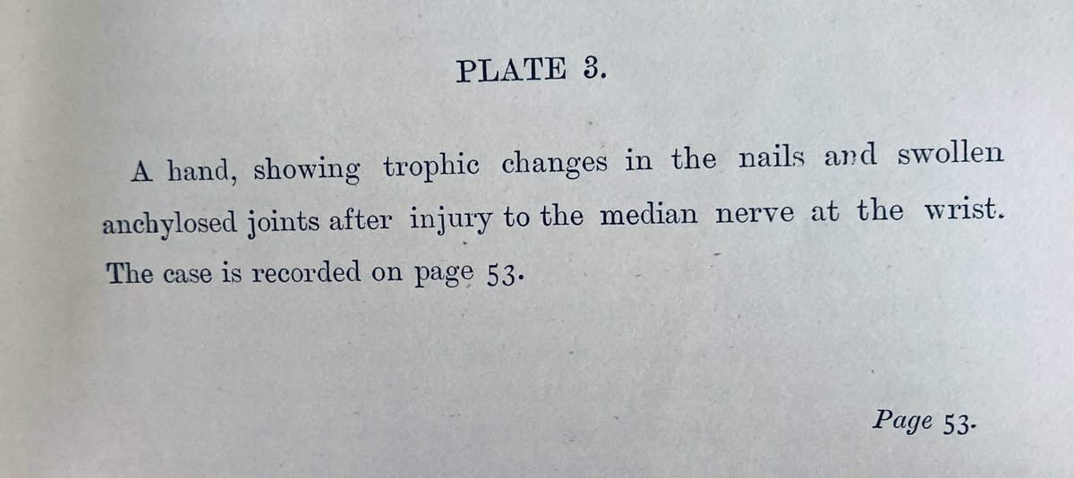TJQPNI's tweet photo. #median #nerveinjury at the wrist demonstrating tropic changes: From 1889 ‘Injuries and disease of nerves’ by A.A.Bowlby #historyofmedicine #meded #surgicalillustration #trauma https://t.co/nXvaQQ9Lgp