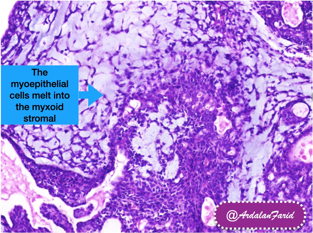 Pleomorphic adenoma in the parotid gland of a 41-year-old female. #OralPath #SurgPath #Pathology