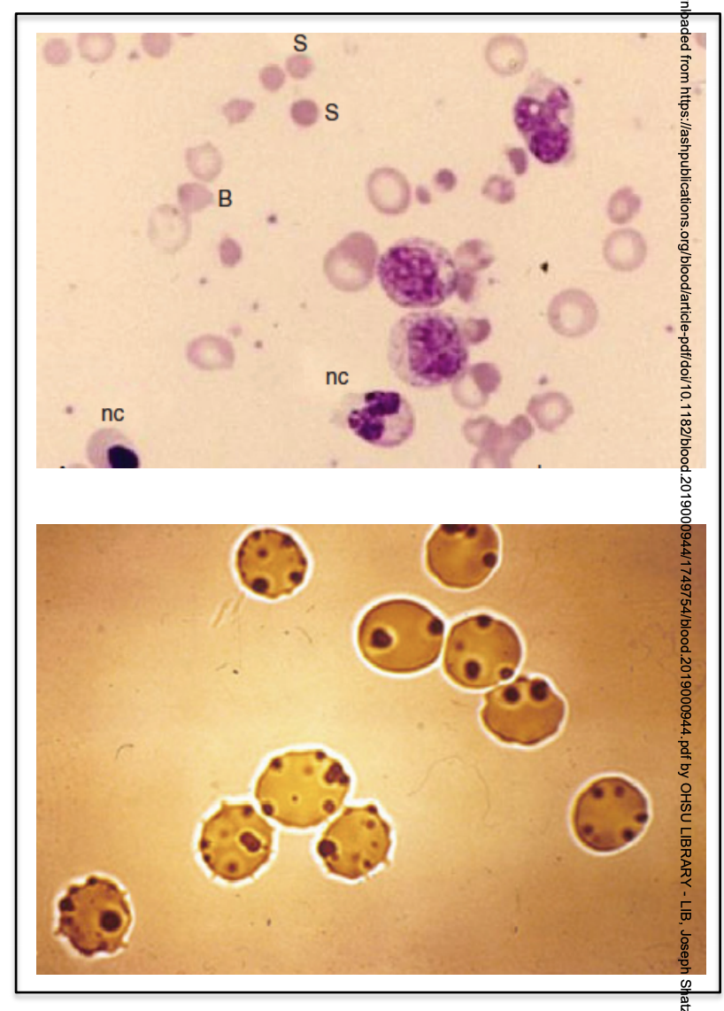 G6pd Deficiency Rbc Inclusions G6pd Deficiency Anemia Blood Smear