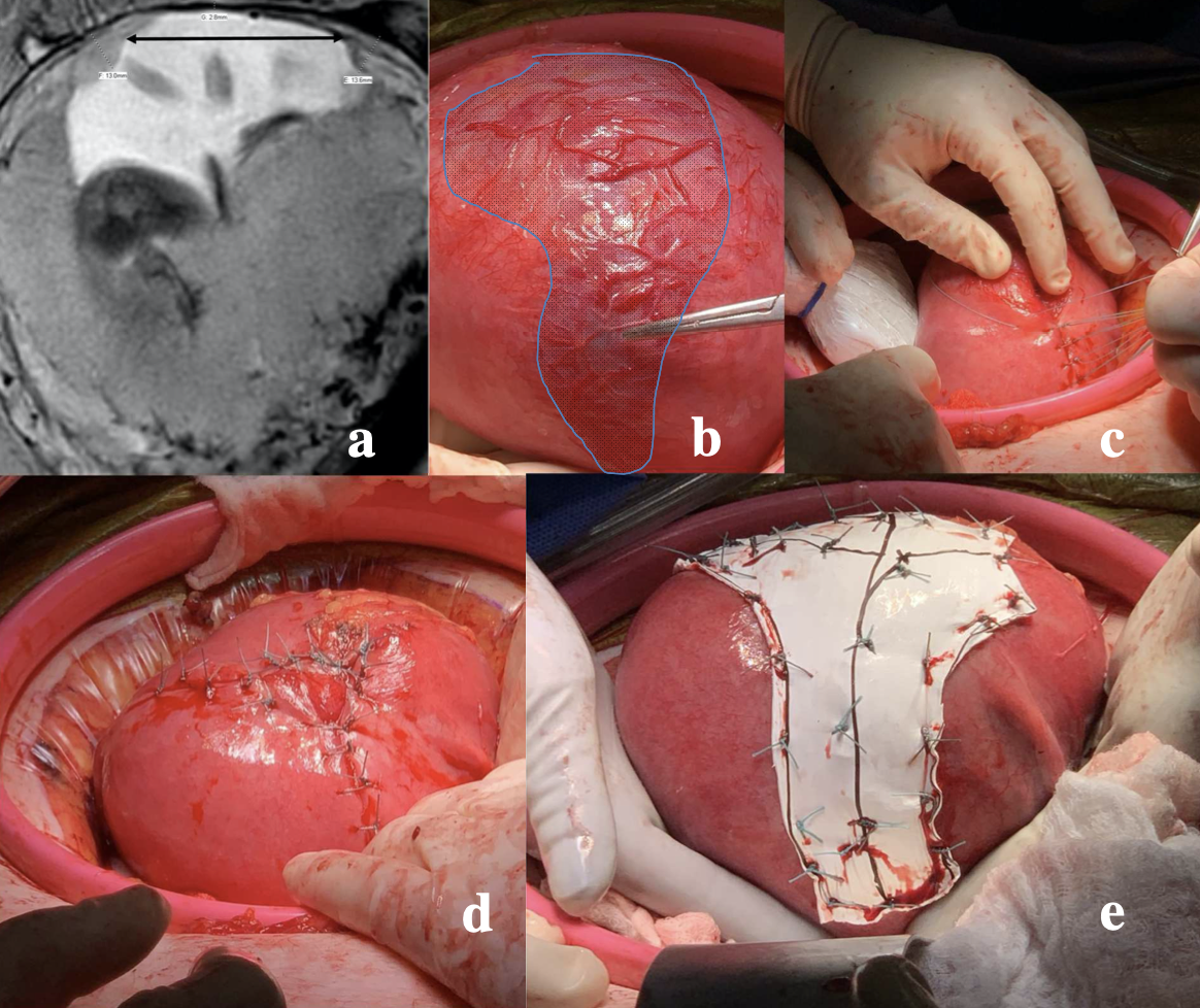 AJOG Surgeon's Corner:  Repair of a large #uterine dehiscence during the second trimester leading to successful prolongation of the #pregnancy. ow.ly/c37Z50AIl9q