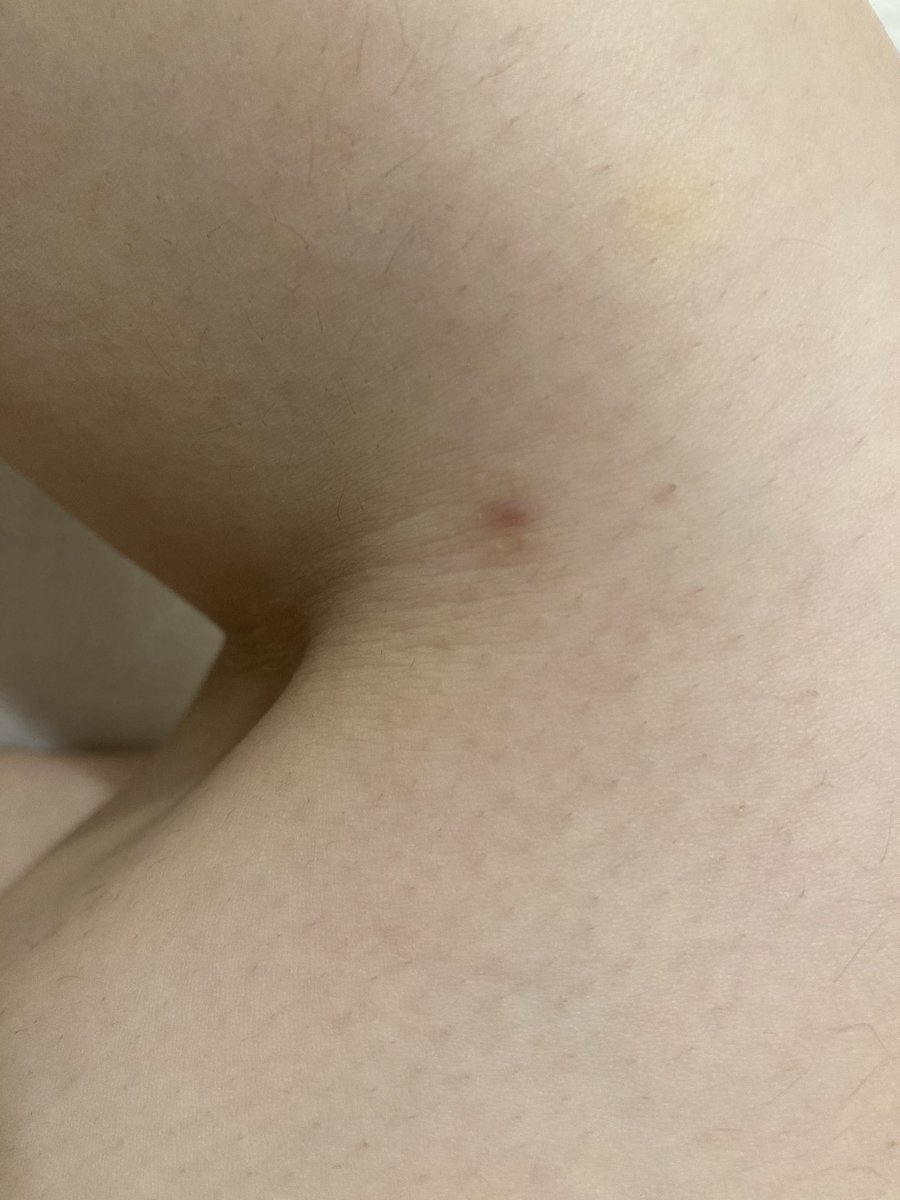 Y25ca's tweet photo. ふくらはぎ脂肪吸引による傷4ヶ月目。
右の膝横？裏？(四枚目)は目立つけどそんな見られないし気にしてない🙆‍♂️ https://t.co/TFbMFntJY0