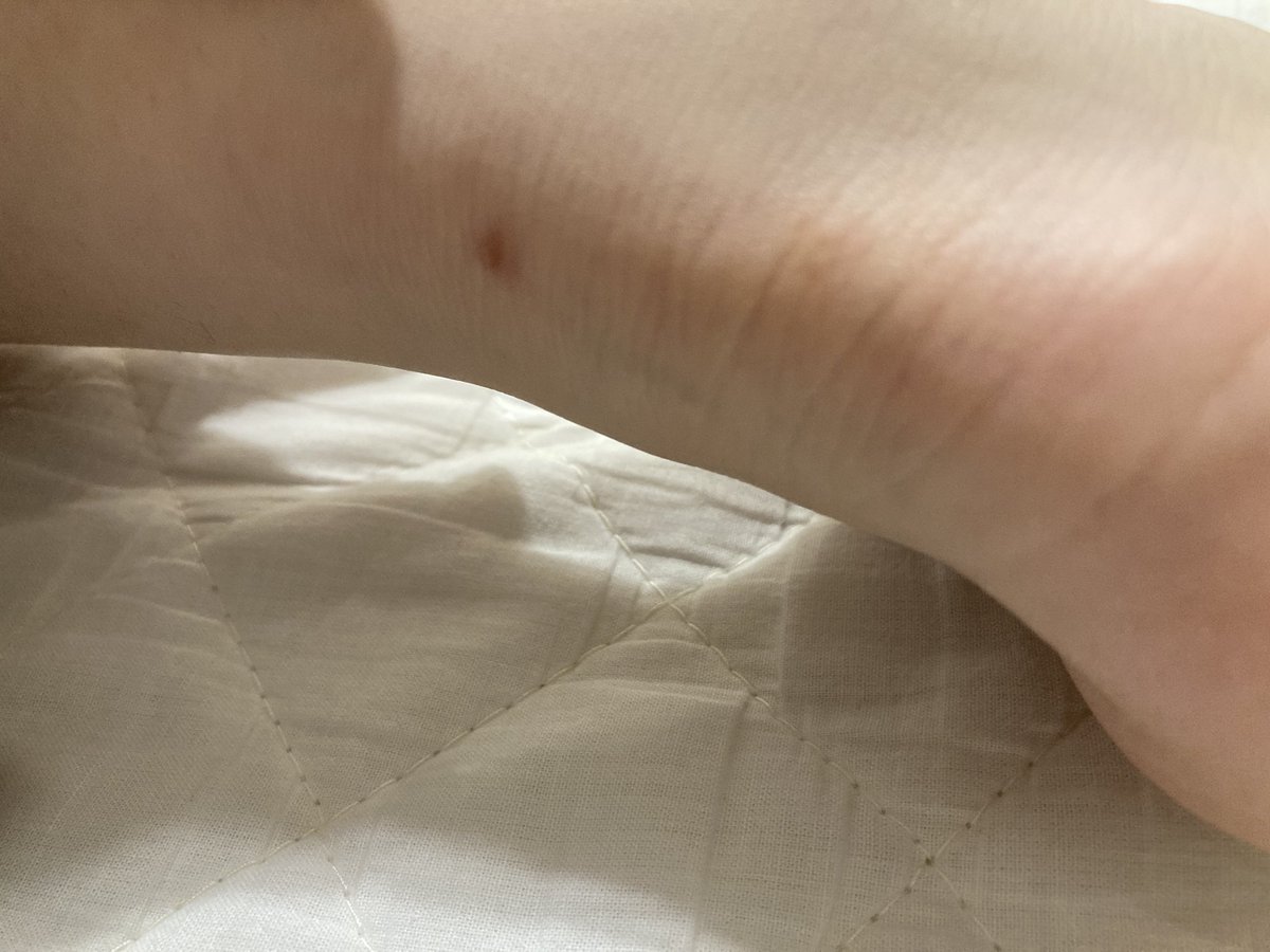 Y25ca's tweet photo. ふくらはぎ脂肪吸引による傷4ヶ月目。
右の膝横？裏？(四枚目)は目立つけどそんな見られないし気にしてない🙆‍♂️ https://t.co/TFbMFntJY0