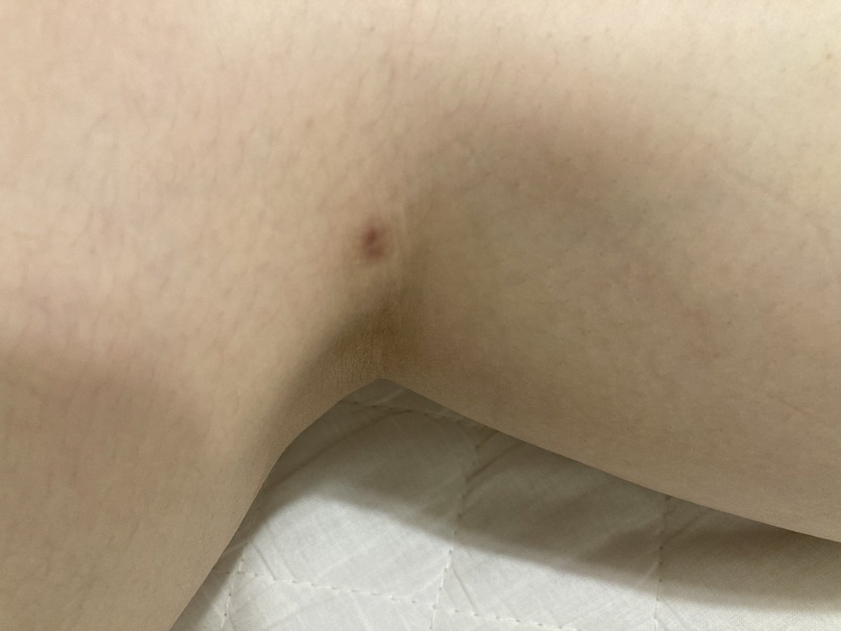 Y25ca's tweet photo. ふくらはぎ脂肪吸引による傷4ヶ月目。
右の膝横？裏？(四枚目)は目立つけどそんな見られないし気にしてない🙆‍♂️ https://t.co/TFbMFntJY0