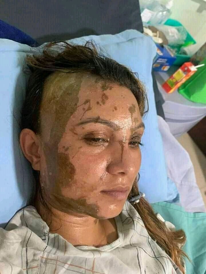 After the recent incident happened on Kathmandu A young girl became victim of acid attack she need justice how can someone damage her life when some one just reject you the criminal should be severely punished .
#justiceforpabitra 
#StopAcidViolence
#Beaman