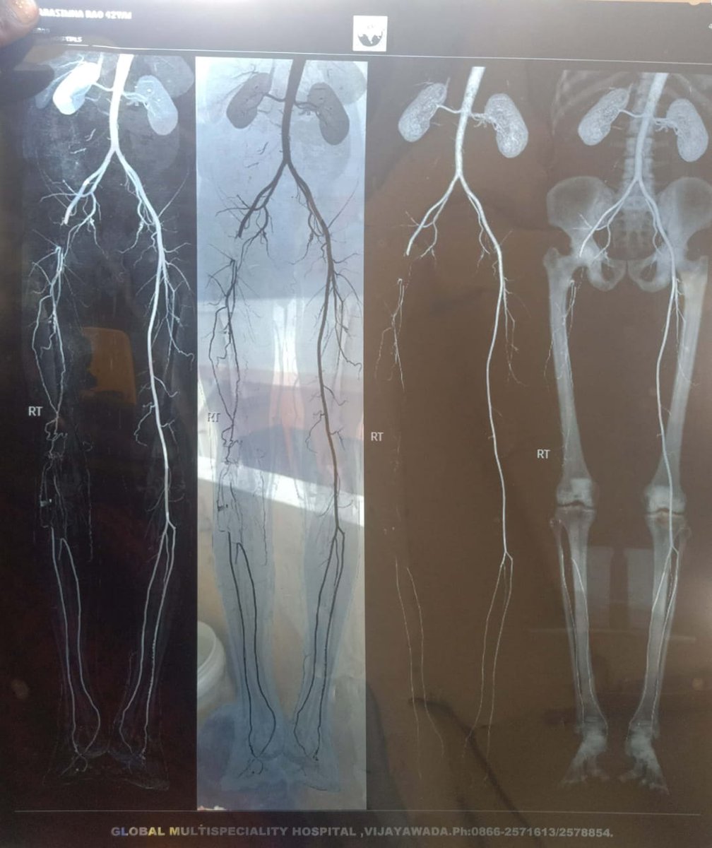 HH_RguktB's tweet photo. Any chance of Balloon/Bypass Surgery for right leg 🙏

@SonuSood Bhai,
Minor Accident but NO Money
(Corona pandemic with zero income) 
for treatment brought him into TERRIBLE CONDITION

Needed Response!
Ur response can save a family 😭

Narasimha,
Autodriver,Agricultural labourer https://t.co/BIbuPAMvYt