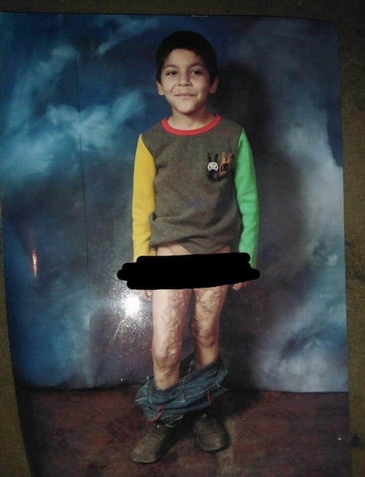 Helpinghands_pk's tweet photo. Child burnt case.

He got burnt in Cylinder blast and he is orphan too.
Please come forward and donate generously.
For details contact 03439045500
#childburntcase #Cylinderblast https://t.co/Y2Q9hzsAsk