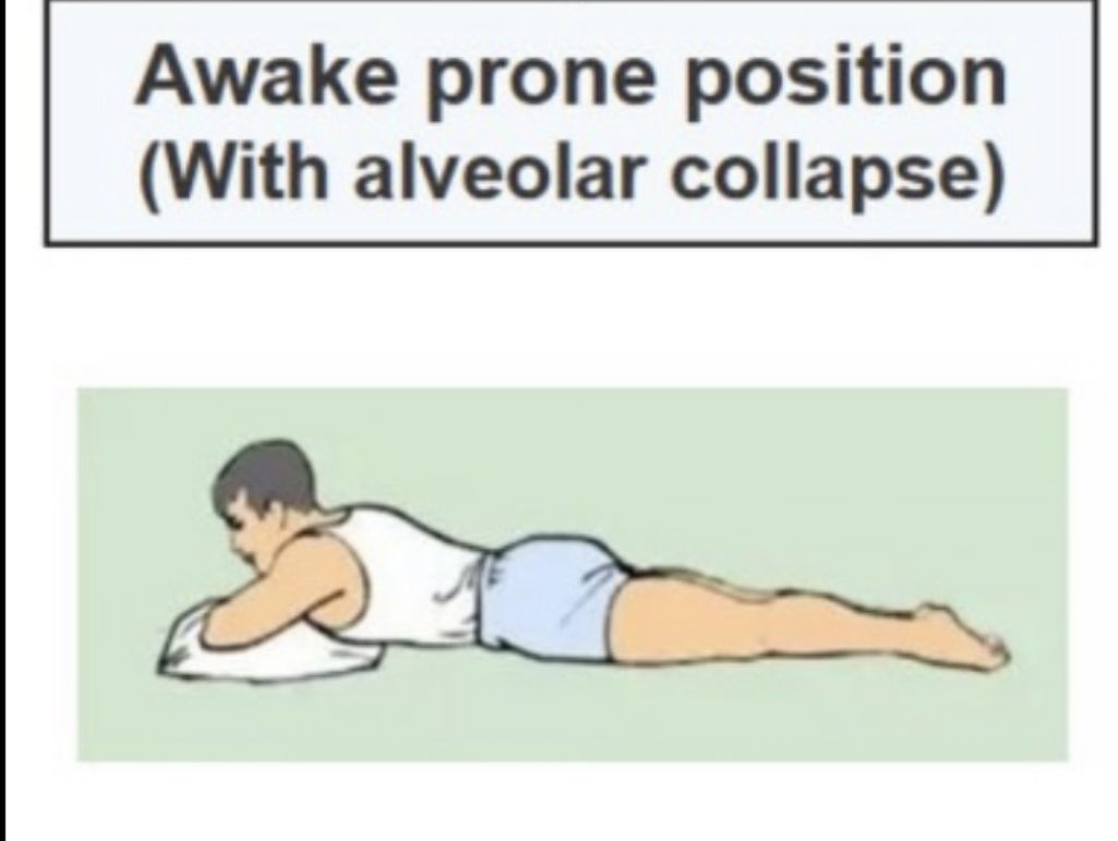 FaheemYounus's tweet photo. What is proning?

Sleeping on your stomach is called PRONING which may improve oxygen levels in COVID pts by opening up the underused back areas of the lung. See pictures

It’s like rotating tires on your car...

May help but is experimental. 👇

https://t.co/KrDMvwbXT7 https://t.co/zE7YxCNeBo