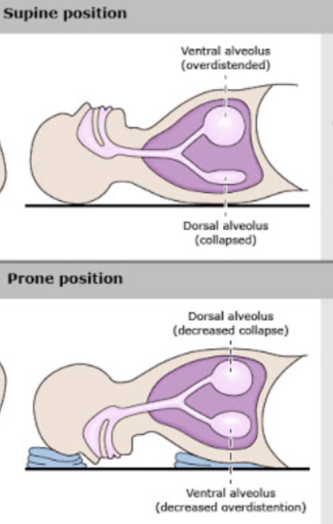 What is proning? Sleeping on your stomach is called PRONING which may improve oxygen levels in COVID pts by opening up the underused back areas of the lung. See pictures It’s like rotating tires on your car... May help but is experimental. 👇 thelancet.com/journals/lanre…