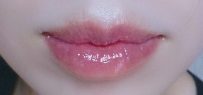 かめ 口元大切 Dt 90日目 3ヶ月 全体的に皮膚が柔らかくなってきました 上唇はほとんど硬さは残ってません 下唇はもう少しです 麻痺に関してはこの時点でもまだ残っています 不自由はないですが 違和感があります 少し皮膚が戻って唇が少し