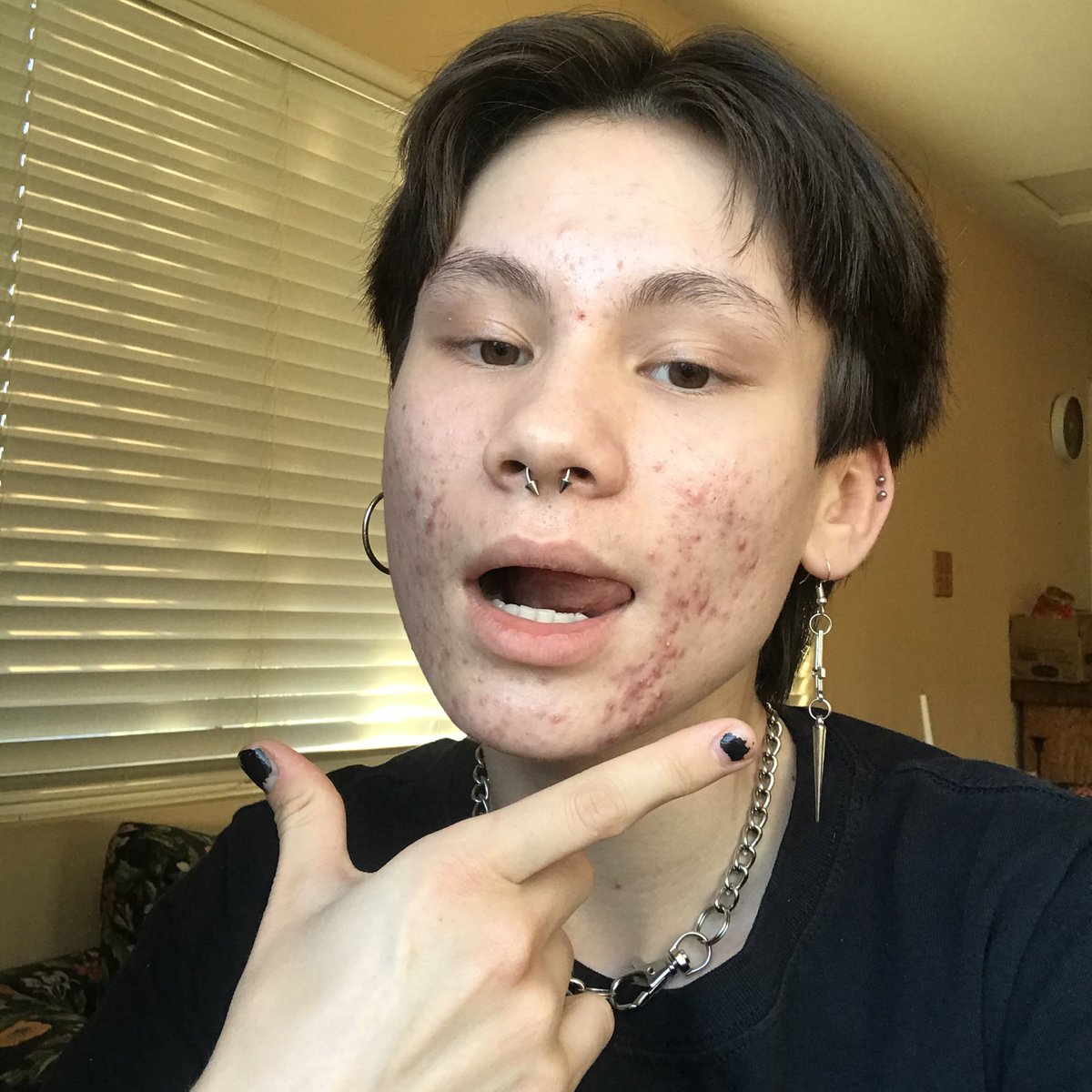 ianaIexander's tweet photo. normalize normal skin!!
🙇🏻‍♂️
i used to be so afraid of how my hormonal acne would affect my ability to get acting roles, well i can tell u from experience it’s worth it to embrace ur true self. anyone that makes u feel ashamed of ur body for ANY reason doesn’t deserve ur time!! 💥 https://t.co/NNcpm2IlWA