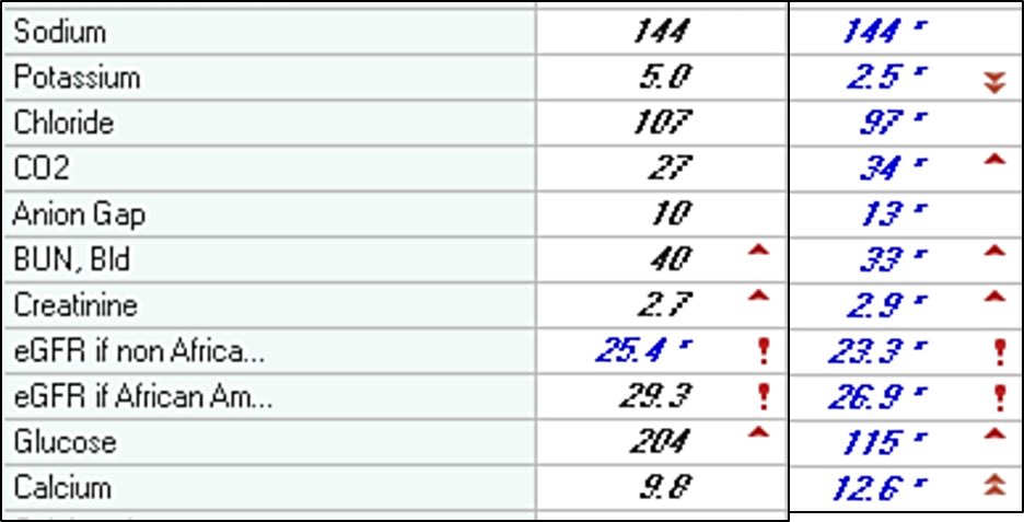 1/lab called to report a serum Ca jump to 12.6 (normal albumin) along with hypokalemia and high serum CO2. PTH 21 (down from 129!), 25 vit D 30. So a PTH-independent case. Pt feels fine and is active. Pt not on calcitriol, vitamin D or thiazide. SPEP and fLC normal.