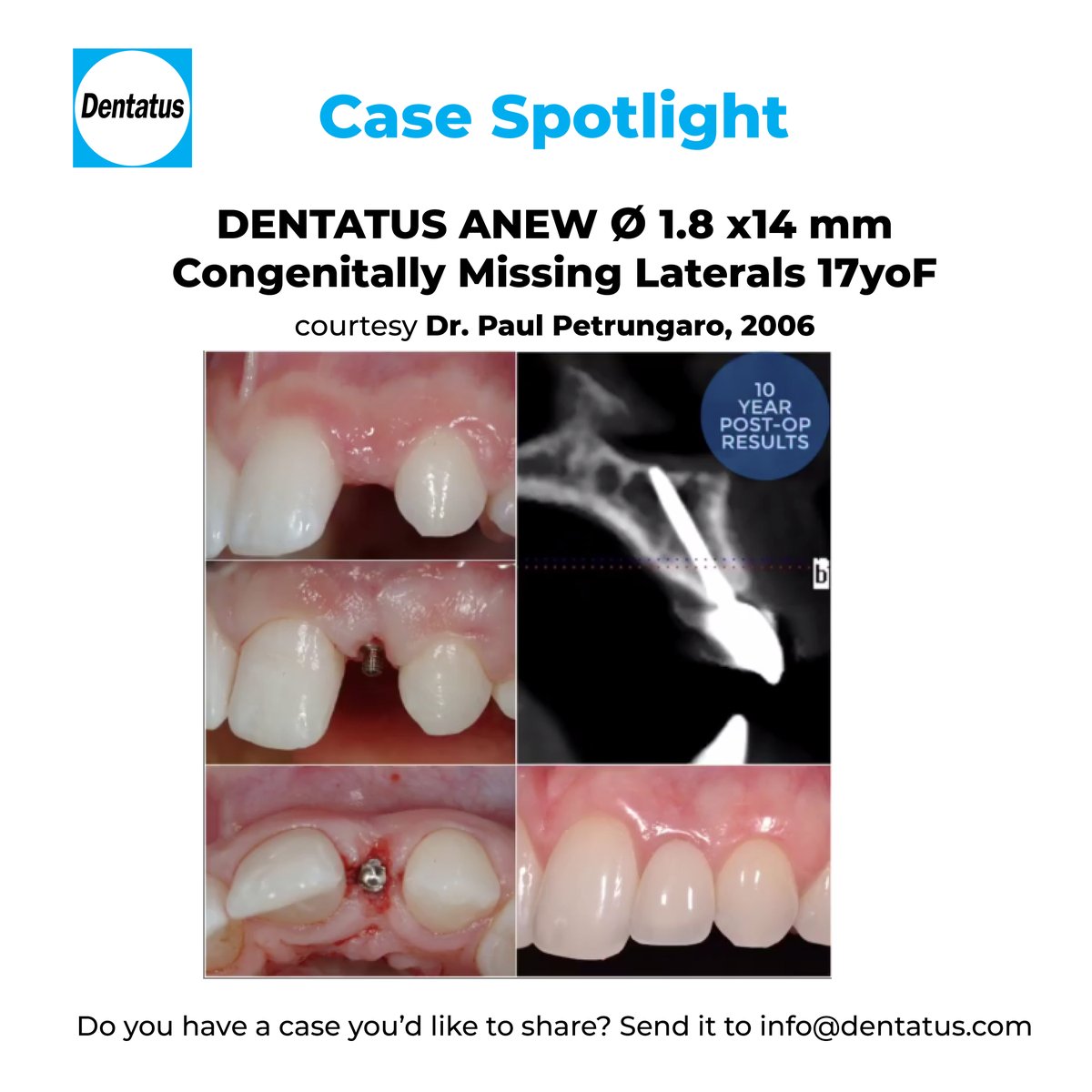DentatusA's tweet photo. Read more about this case here: https://t.co/qjvK5f8wWT
TAG: @StartSmilingChi @AEGISDental
#dentatus #dentatusimplants #narrowdiameterimplants #implantdentistry #dentalimplants #dentistry #beforeandafter #bestsmile #smilegoals https://t.co/kgRyBGdYGe