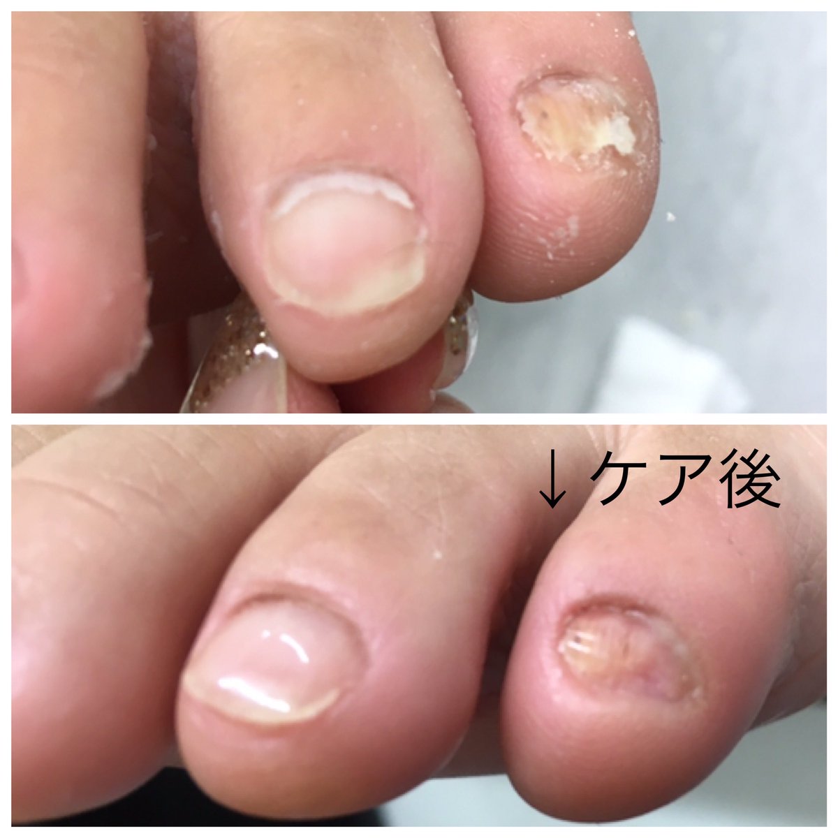 末広町駅 徒歩１分の痛くない巻き爪ケアサロン Makizume Wrnail Twitter