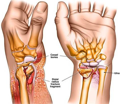 ctod_editor's tweet photo. #CTOD Minimally invasive closed reduction and internal fixation with fully threaded headless cannulated compression screws for repair of distal radius fracture: study protocol for a randomized controlled trial
#distalradiusfracture #minimallyinvasive

https://t.co/ELRVajYR1n https://t.co/wRjCuvf2SN
