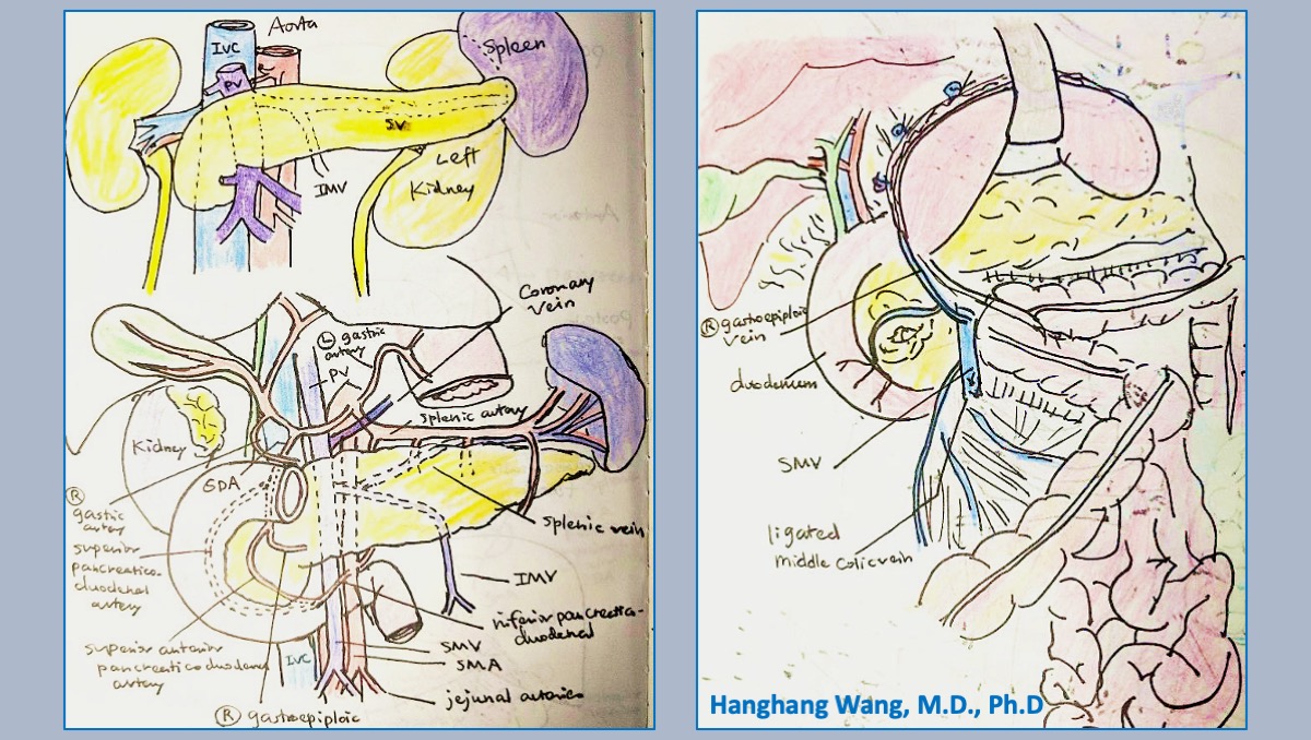 Move over Netter! Today we're featuring #MedicalArt from #YoungAlumni @HHW_MDPhD. We think in another life she was surely destined to be a #PancreaTITAN. #Michelangelsew #RaphaeLHook #KahlosTriangle #SabistonSquad #CityofSurgery @DukeSurgery @hopkinssurgery