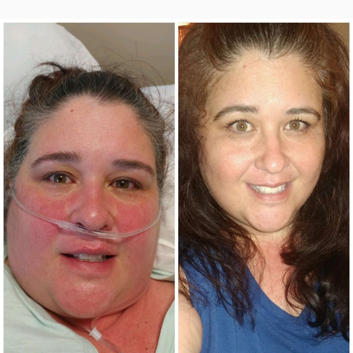 RachelMilstead3's tweet photo. Today marks 2 months since I was hospitalized with Covid and double pnuemonia. I spent 12 days in the hospital and recieved #Remdesivir and #convalescentplasma . Still recovering slowly, but blessed to be alive #COVID19 #covidsucks https://t.co/iVHhMR408b