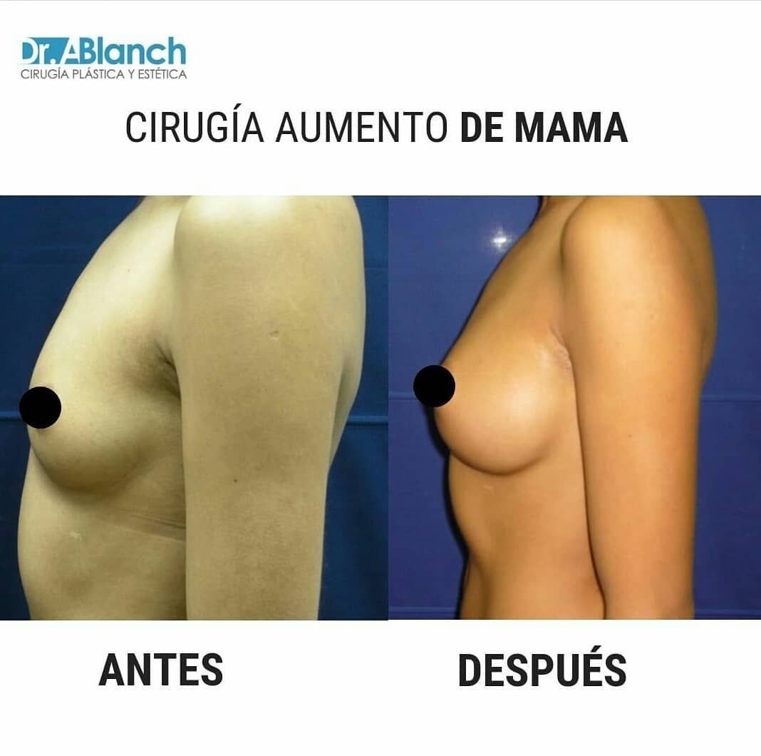 DrBlanch's tweet photo. 🤔 ¿Estás pensando en realizarte una cirugía mamaria? ¡Ahora es es el momento!
📩 Para cualquier duda estamos a tu disposición vía mail en carme.drblanch@gmail.com
#cirugiamamaria #aumentodemamas #mamas #aumentodepecho #cirugia #cirugiaestetica #cirugiaplastica #antesydespues https://t.co/bRqSt35wne