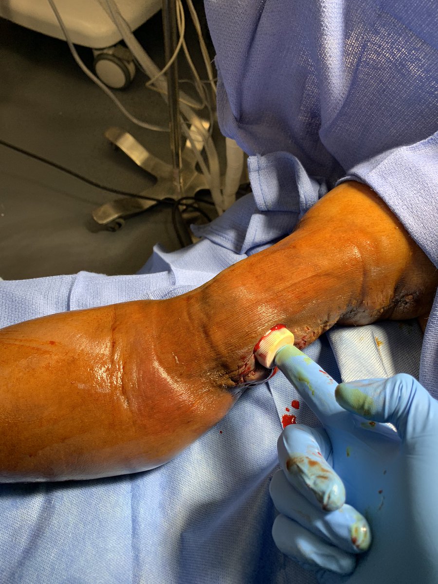 Kuldeep1926's tweet photo. IT WORKS! Tweak to the bottle cap trick. cap filled with thrombin+ bleeding AVF= instant clot. No pressure needed.  Share the knowledge and save blood. #VascularSurgery .@VascularSVS .@VascularOnline .@FutureVascSurgn .@nkf  @NorthwellHealth @SIUHOSPITAL .@EVToday @abbashu https://t.co/L9WwVBEw6d