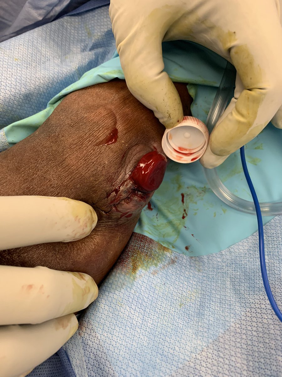 Kuldeep1926's tweet photo. IT WORKS! Tweak to the bottle cap trick. cap filled with thrombin+ bleeding AVF= instant clot. No pressure needed.  Share the knowledge and save blood. #VascularSurgery .@VascularSVS .@VascularOnline .@FutureVascSurgn .@nkf  @NorthwellHealth @SIUHOSPITAL .@EVToday @abbashu https://t.co/L9WwVBEw6d