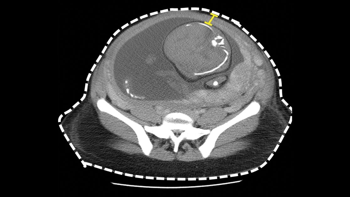 RadioGraphics's tweet photo. A practical primer on fetal CT dosimetry and potential biologic effects for the radiologist. https://t.co/83twIGphFx #ImagingPhysics #CTRad #RadCME https://t.co/obwJ06aWKH