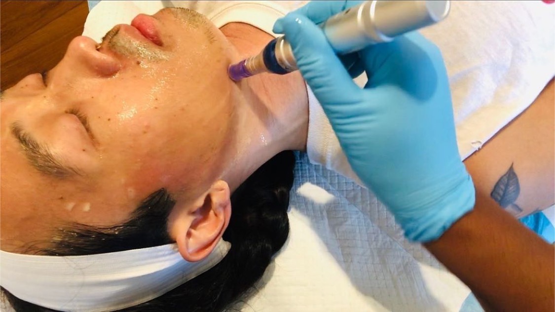 juventix's tweet photo. Microneedling for men! Men can also rejuvenate their skin with a Microneedling with PRP facial, demonstrated in this photo. 
To purchase Microneedling Derma Pen &amp; Needles please visit our website,
https://t.co/zhaxCos0tv

#JuventixRegenerativeMedical #Juventix #PRP #PRPKit https://t.co/dADJGA8IFO
