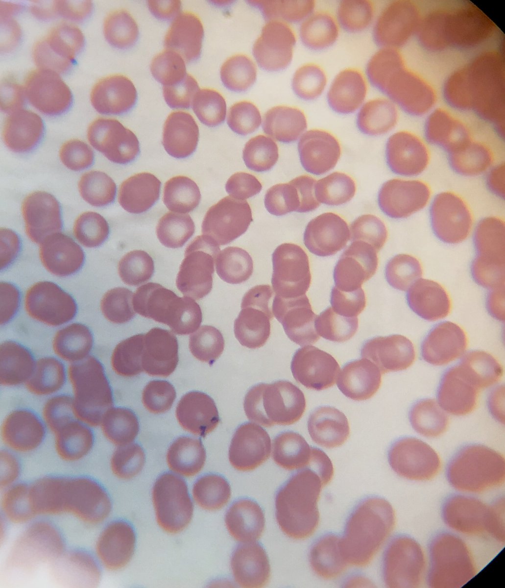 Yo ocupo la tincion de May-Grünwald Giemsa para buscar hemoparasitos. Los puntos o inclusiones de color morado dentro de los glóbulos rojos/eritrocitos son hemoparasitos. Se darán cuenta que son diferentes porque siempre hay co-infecciones, es decir, dos o más parásitos.
