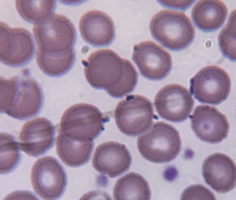 Yo ocupo la tincion de May-Grünwald Giemsa para buscar hemoparasitos. Los puntos o inclusiones de color morado dentro de los glóbulos rojos/eritrocitos son hemoparasitos. Se darán cuenta que son diferentes porque siempre hay co-infecciones, es decir, dos o más parásitos.