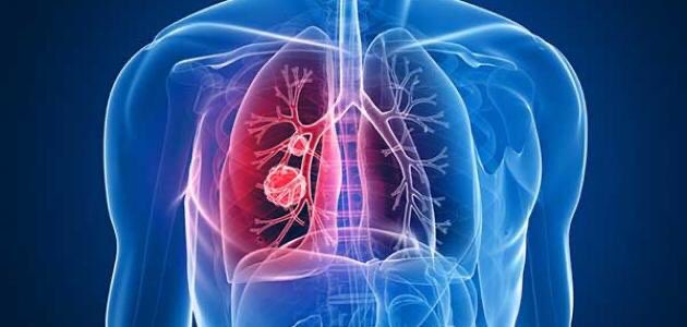 Hethq_'s tweet photo. سرطان الرئة | Lung Cancer
ثريد مهم يتكلم عن سرطان الرئة وأسبابه وأنواعه وأعراضه والوقاية وعلاجه بالأدوية وجراحياً ⬇️ https://t.co/UPCAtm3RR5