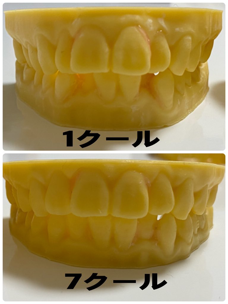 mmm48696917's tweet photo. 歯型ジェンガは崩れて出来なかったけど、最終クールまで歯型貰ったから比較！
少しでも矯正を考えてる、今矯正中って方々の参考になれば✨ https://t.co/abw3iYHMDK