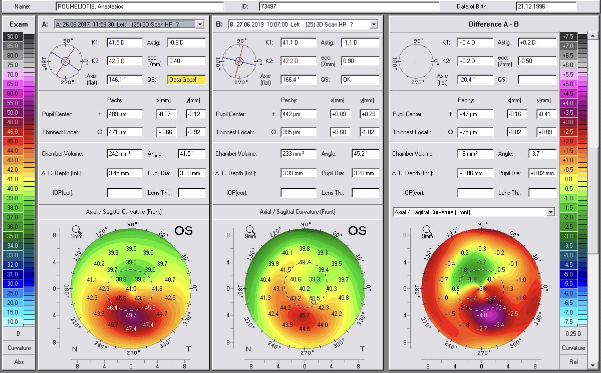 KanellopoulosMD's tweet photo. @KeratoconusGRP The other eye of the same patient had more advanced #Keratoconus and underwent our #AthensProtocol #cxl, improved from 2050 to 20/20 stable in our 2 year Data and the images at 3 years he sent us from Chicago! https://t.co/G7txPxJ7qP