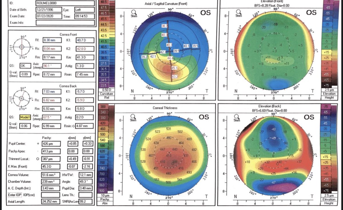 KanellopoulosMD's tweet photo. @KeratoconusGRP The other eye of the same patient had more advanced #Keratoconus and underwent our #AthensProtocol #cxl, improved from 2050 to 20/20 stable in our 2 year Data and the images at 3 years he sent us from Chicago! https://t.co/G7txPxJ7qP