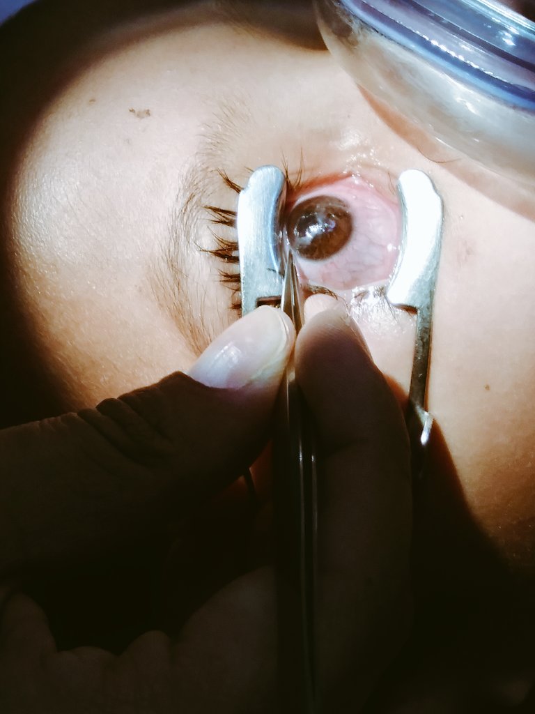 karen_avalos96's tweet photo. Herida corneal. #retirodepuntos #optometry #oftalmology 🤓🤕 https://t.co/eJ2GXN3xXu