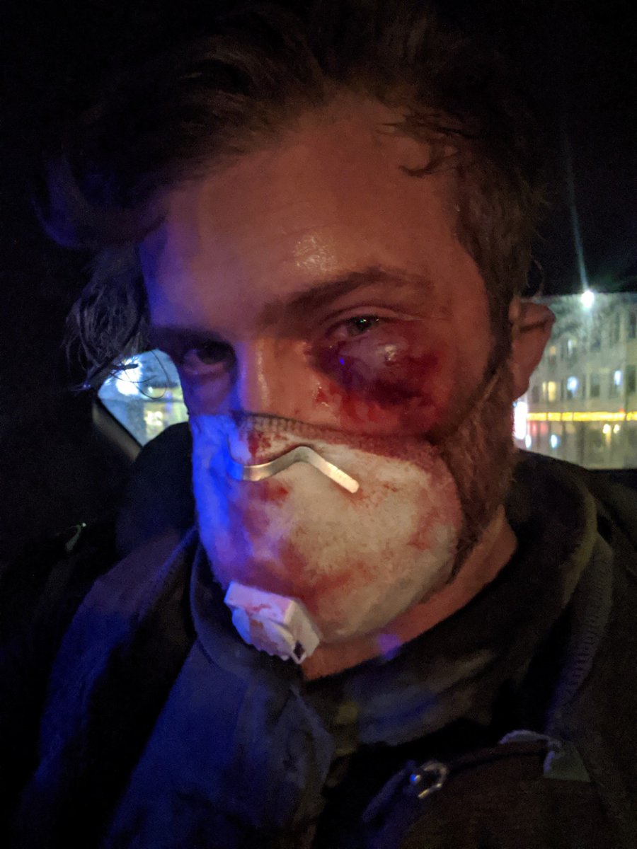 Federal agents shot me in the face last night. Federal agents shot me in the face last night while I was covering the Black Lives Matter protests in Portland. It should be clear to everyone by now that BIPOC face a higher risk of violence by police than I do. Story in comments.