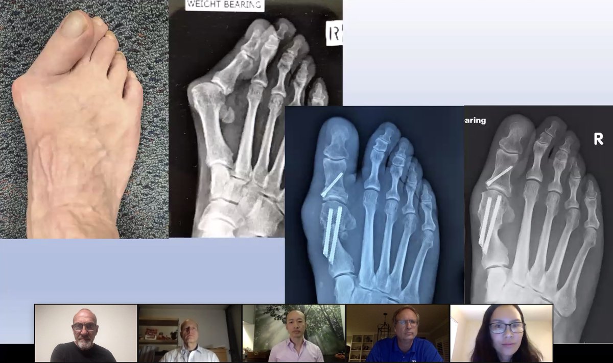 Steps2Walk's tweet photo. Thank You ❤️
We would like to thank all the faculty members, partners, translators & participants for helping us organize this two part webinar on Hallux Valgus.
#steps2walk https://t.co/NWeb8d0TPk