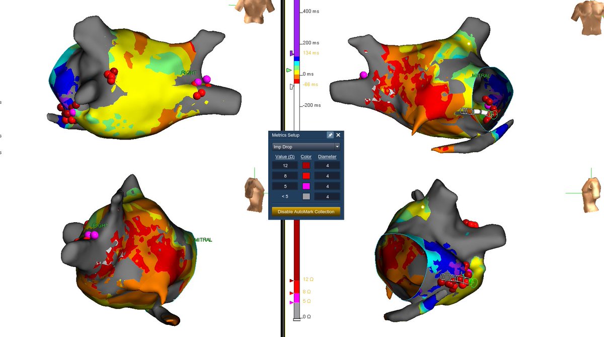 szufski1's tweet photo. Had the privilege to map with @redball_express and #jclancy atypical flutter in setting of previous PVI. Excellent work by our local fellows. Dedication is seen and results like this are proof. #hdgrid @AbbottCardio #alwaysbemapping https://t.co/a1jR2uqReE
