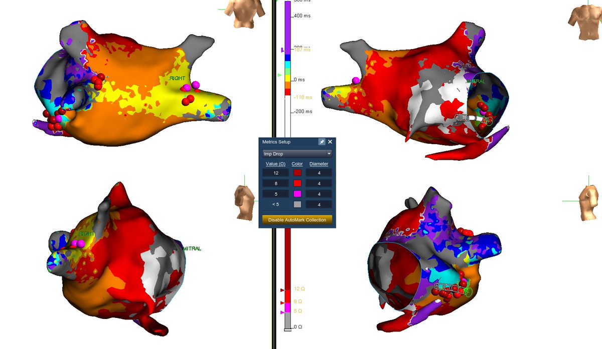 szufski1's tweet photo. Had the privilege to map with @redball_express and #jclancy atypical flutter in setting of previous PVI. Excellent work by our local fellows. Dedication is seen and results like this are proof. #hdgrid @AbbottCardio #alwaysbemapping https://t.co/a1jR2uqReE