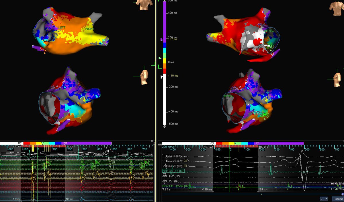 szufski1's tweet photo. Had the privilege to map with @redball_express and #jclancy atypical flutter in setting of previous PVI. Excellent work by our local fellows. Dedication is seen and results like this are proof. #hdgrid @AbbottCardio #alwaysbemapping https://t.co/a1jR2uqReE