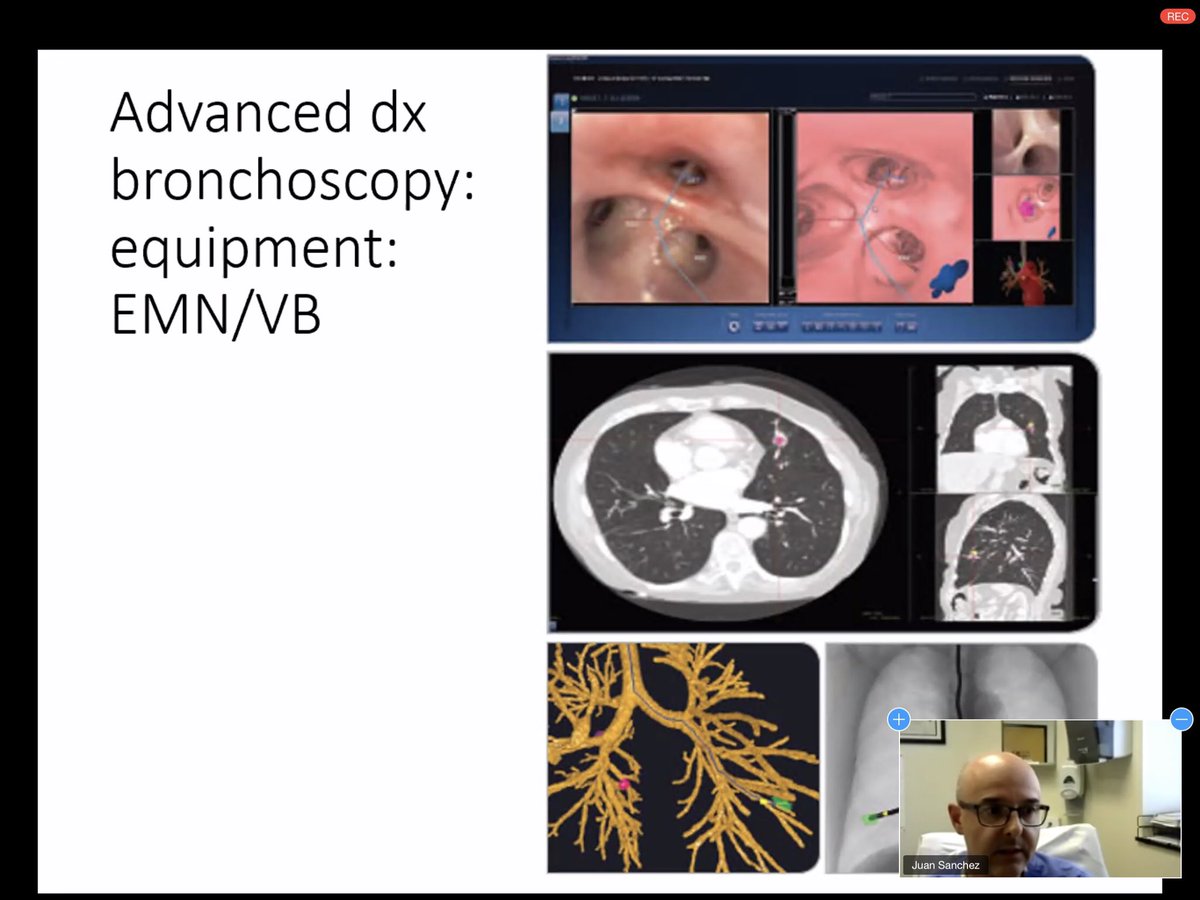 sfaiz212's tweet photo. Great case based and interactive discussion of #EMN #Bronchoscopy at #SWRegBootCamp by #IP @JuanFSanchez8 @BSWHTemple_PCC #MedEd #PulmCC @TulanePCCM @McGovernPulmCC @BCM_Lung @UTHSA_PCCM @redraiderpulmcc @sursar @Donicme https://t.co/itKUCUc8hr