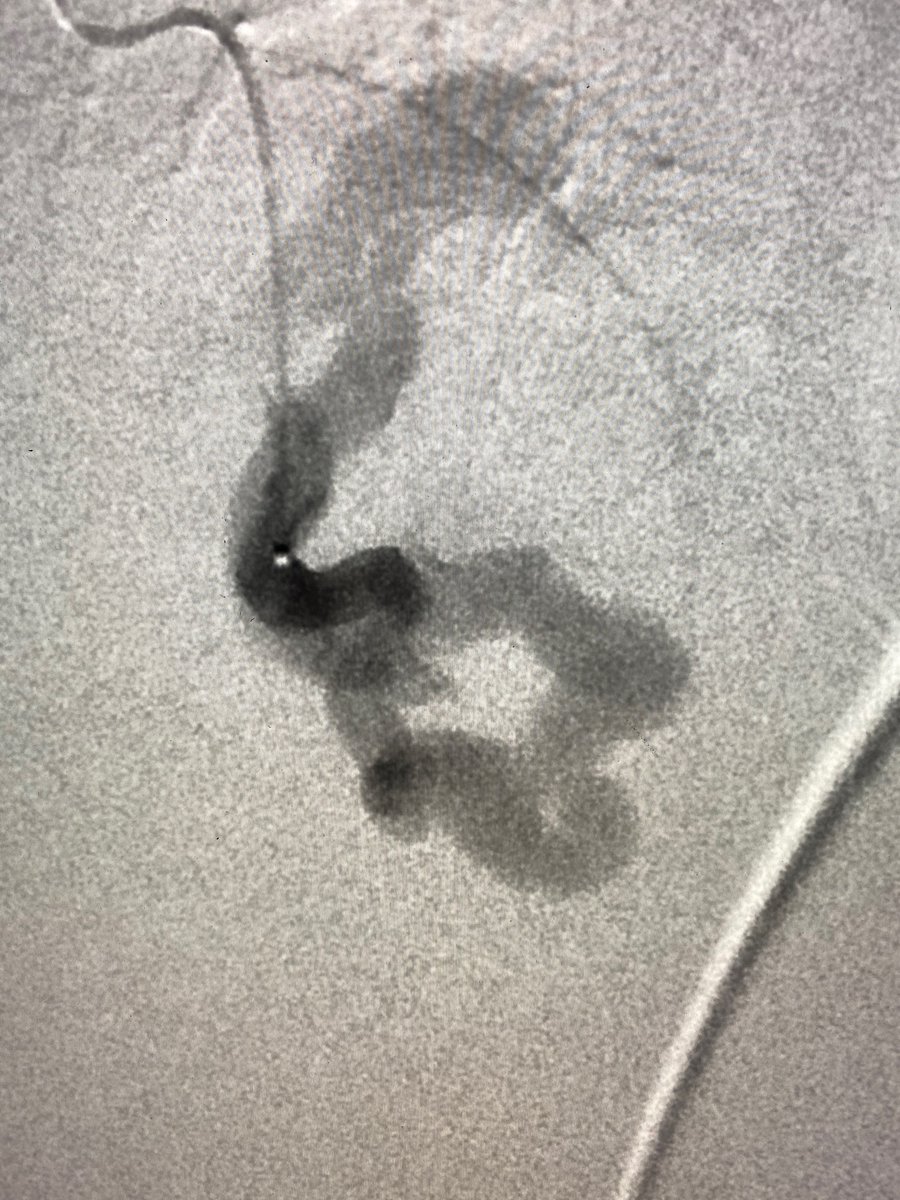 AustinBourgeois's tweet photo. Pulmonary AVM with 6.5mm feeding artery embolized with 8mm POD & 60cm packing coil. pAVMs are abnormal conduits between arteries and veins that reduce oxygen levels, can cause stroke or heart failure symptoms. Treatment usually occurs with symptoms or artery >3mm. #iRad https://t.co/XUTzkTmpoB
