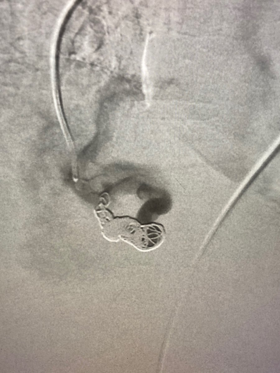 AustinBourgeois's tweet photo. Pulmonary AVM with 6.5mm feeding artery embolized with 8mm POD & 60cm packing coil. pAVMs are abnormal conduits between arteries and veins that reduce oxygen levels, can cause stroke or heart failure symptoms. Treatment usually occurs with symptoms or artery >3mm. #iRad https://t.co/XUTzkTmpoB
