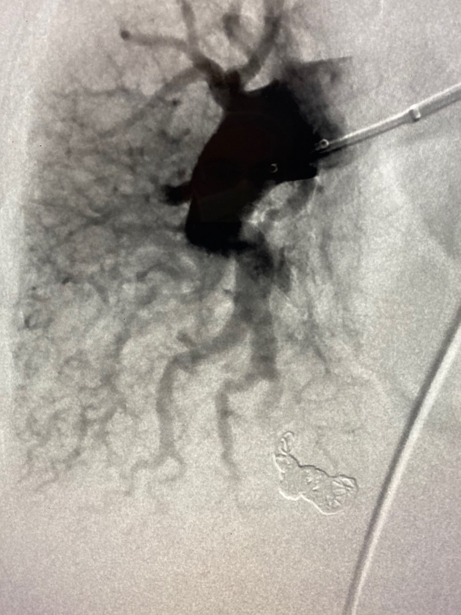 AustinBourgeois's tweet photo. Pulmonary AVM with 6.5mm feeding artery embolized with 8mm POD & 60cm packing coil. pAVMs are abnormal conduits between arteries and veins that reduce oxygen levels, can cause stroke or heart failure symptoms. Treatment usually occurs with symptoms or artery >3mm. #iRad https://t.co/XUTzkTmpoB
