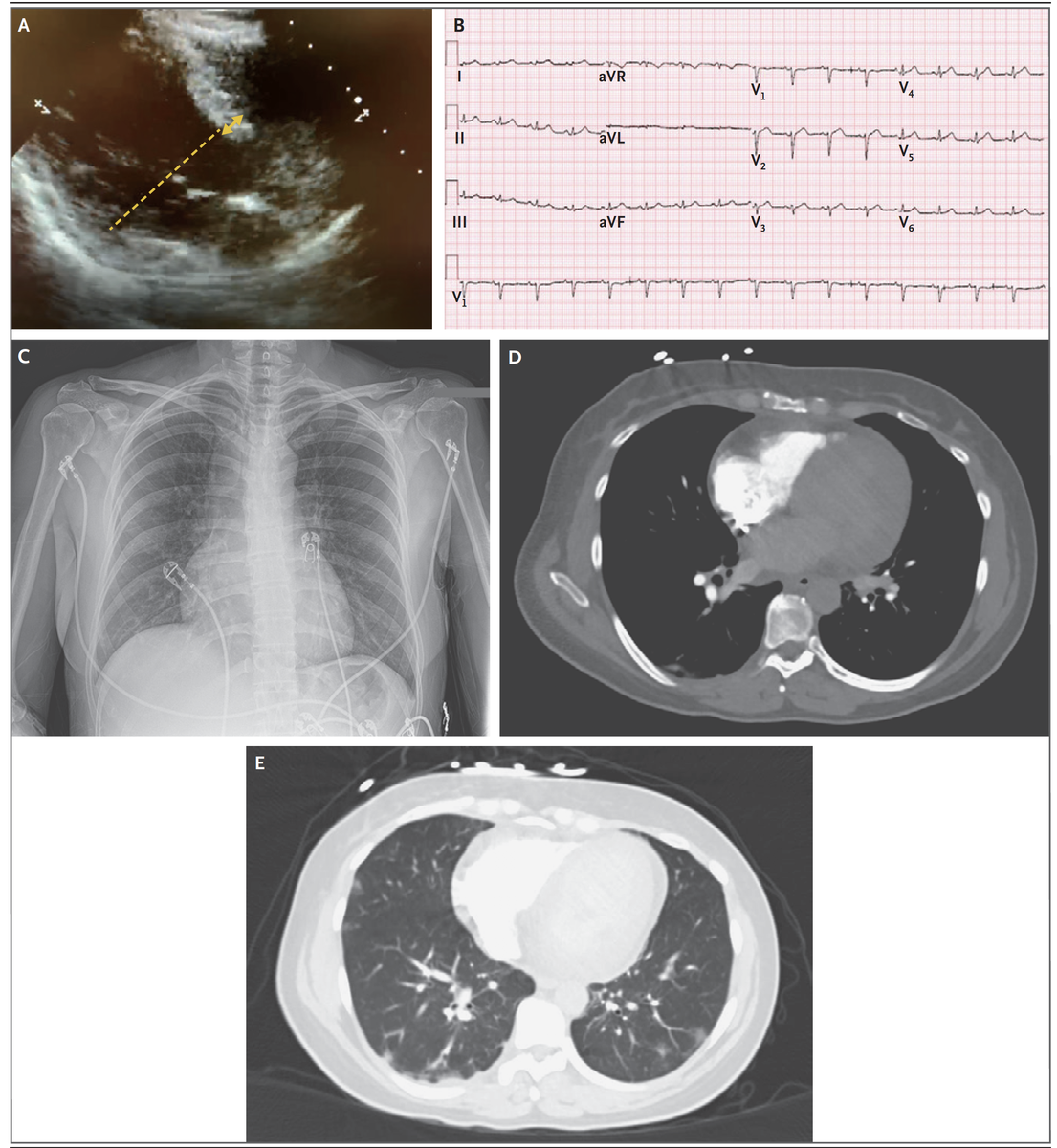 EricTopol's tweet image. A 44-year-old woman with #SARSCoV2 related severe cardiomyopathy and cardiogenic shock is presented in- depth @NEJM today. Instructive for differential diagnosis and the outstanding management she received that led to a very favorable outcome nejm.org/doi/full/10.10…