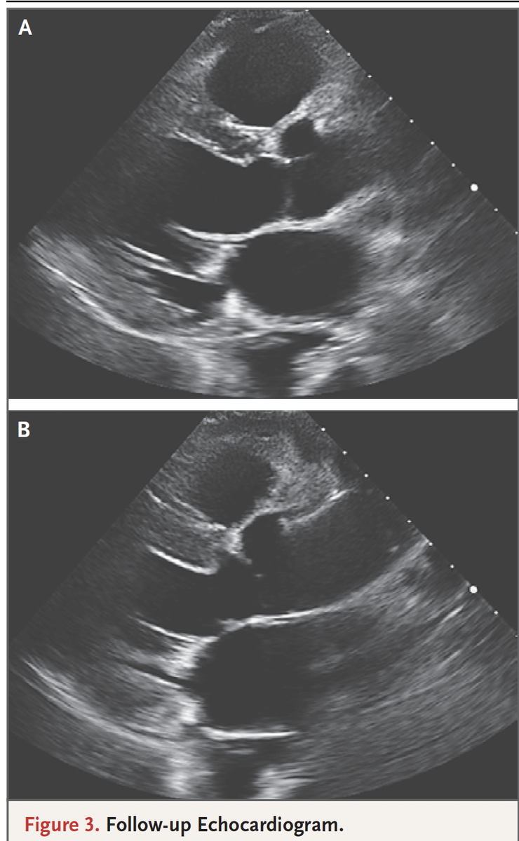 EricTopol's tweet image. A 44-year-old woman with #SARSCoV2 related severe cardiomyopathy and cardiogenic shock is presented in- depth @NEJM today. Instructive for differential diagnosis and the outstanding management she received that led to a very favorable outcome nejm.org/doi/full/10.10…