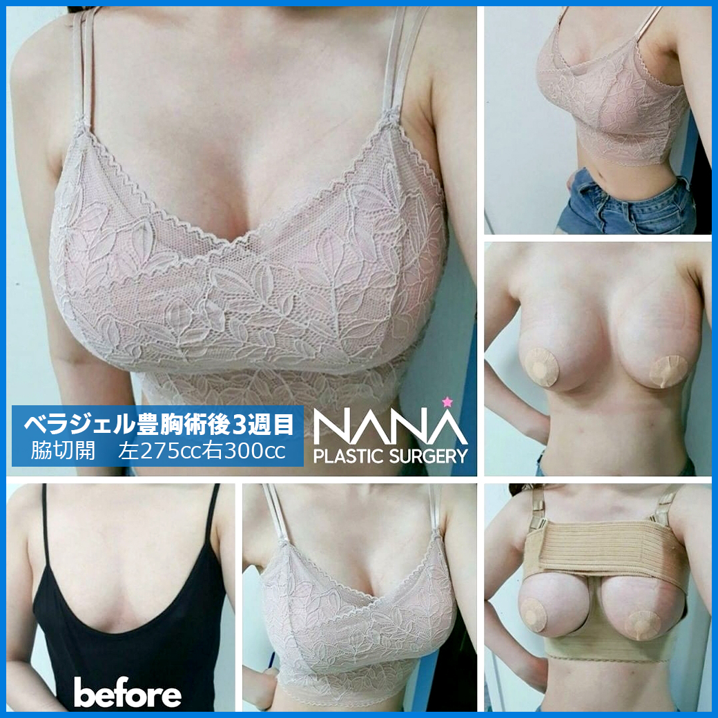 韓国整形 #NANA豊胸 #ビフォーアフター 術後3周目 ⭐#シリコンバック
