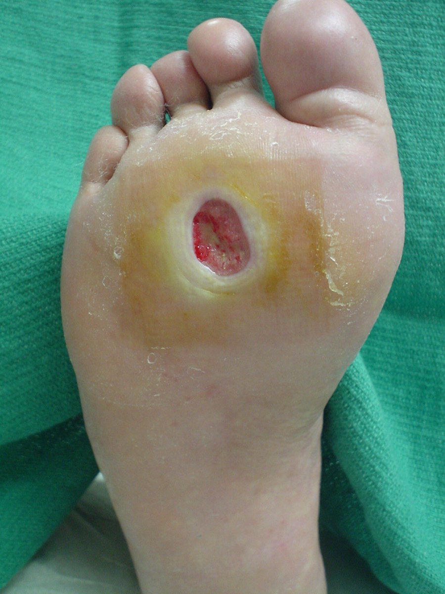 Diabetic Foot Ulcer! (DFU)Diabetes mellitus (DM) is responsible for over 50% of all foot Amputations! A thread! Please share and RT for awareness!