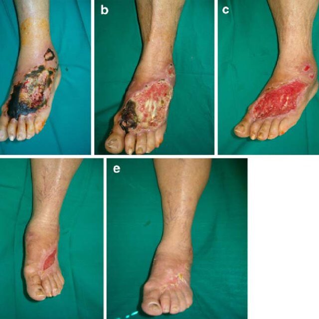Diabetic Foot Ulcer! (DFU)Diabetes mellitus (DM) is responsible for over 50% of all foot Amputations! A thread! Please share and RT for awareness!