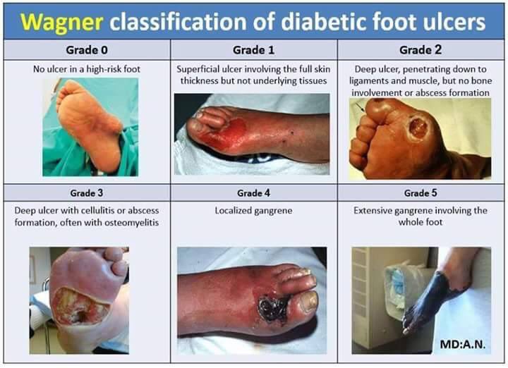 * There are 5 grades of DFU * Grade 0: intact skin* Grade 1: surface ulcer * Grade 2:deep tissue (bones/tendon or joints)* Grade 3: deep ulcer, with abscess or bone tissue inflammation * Grade 4: gangrenous (infected) fore foot! * Grade 5: the whole foot becomes infected