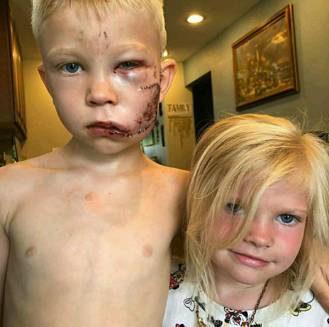 _SJPeace_'s tweet photo. BROTHER OF THE YEAR! 

This six-year old boy jumped in front of a charging dog to save his little sister. 90 stitches! 😭❤️

He said “If someone had to die, I thought it should be me.” 🥺

Young hero's name is Bridger. KNOW HIS NAME! https://t.co/n5BQR8QhWC