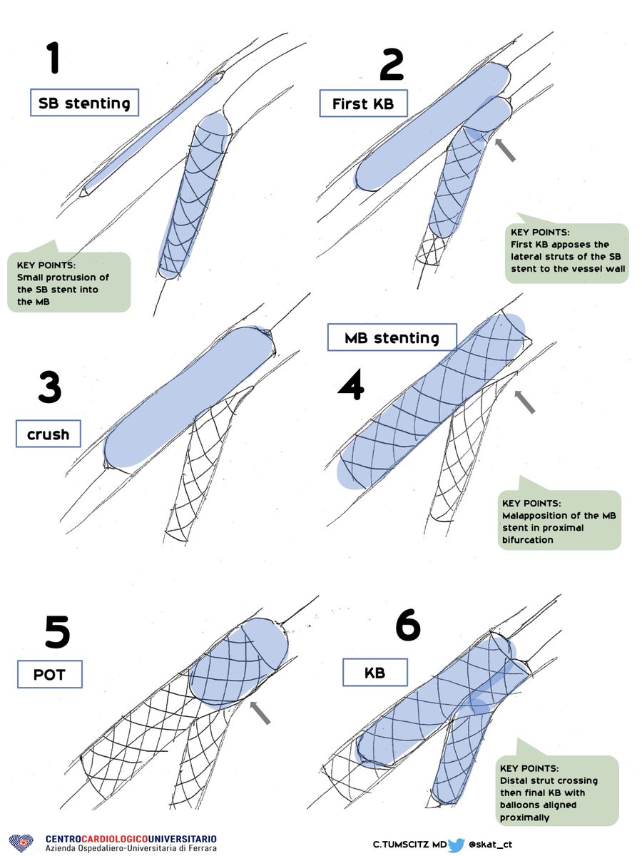 Carlo Tumscitz (@skat_ct) on Twitter photo Step by step flowchart of our "minimalist" version of the #NanoCrush bifurcation technique. Some slight differences, much easier than #DKCrush. <a href="/DrArifK/">Arif Khokhar</a> <a href="/CristinaM0relli/">Cristina.M</a> #radialfirstBot <a href="/ShariqShamimMD/">Dr Shariq Shamim</a> <a href="/SimoneBiscaglia/">Simone Biscaglia</a> <a href="/PCRonline/">PCRonline 🫀</a> #EAPCI Step by step flowchart of our "minimalist" version of the #NanoCrush bifurcation technique. Some slight differences, much easier than #DKCrush. <a href="/DrArifK/">Arif Khokhar</a> <a href="/CristinaM0relli/">Cristina.M</a> #radialfirstBot <a href="/ShariqShamimMD/">Dr Shariq Shamim</a> <a href="/SimoneBiscaglia/">Simone Biscaglia</a> <a href="/PCRonline/">PCRonline 🫀</a> #EAPCI